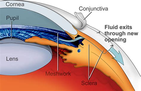 cpt code for trabeculectomy with mitomycin c|Eye Trabeculectomy 2 pubs